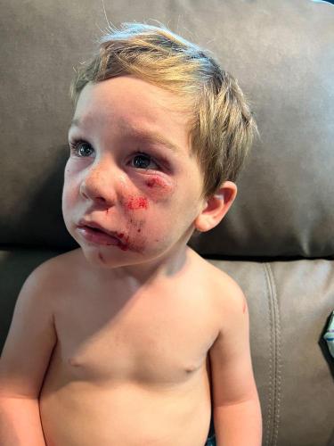 20220628 7713-bike-accident-Indian-Lakes-IN