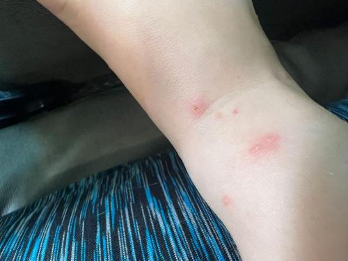 ant-bites-lake-tawakoni